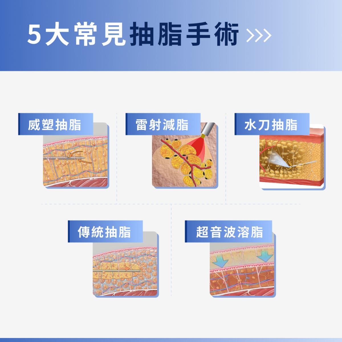 5 大抽脂手術